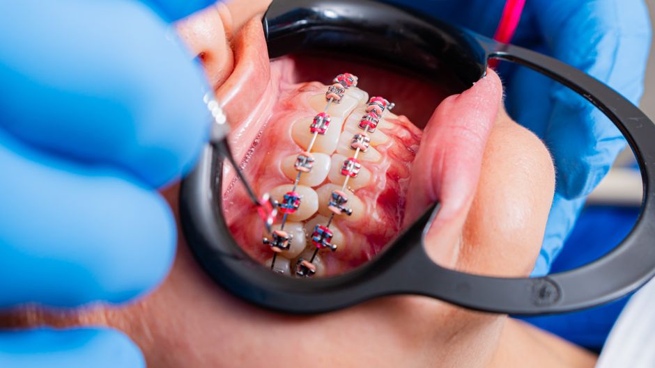 Braces Care Tips for Florence Teens: Food, Flossing, Comfort